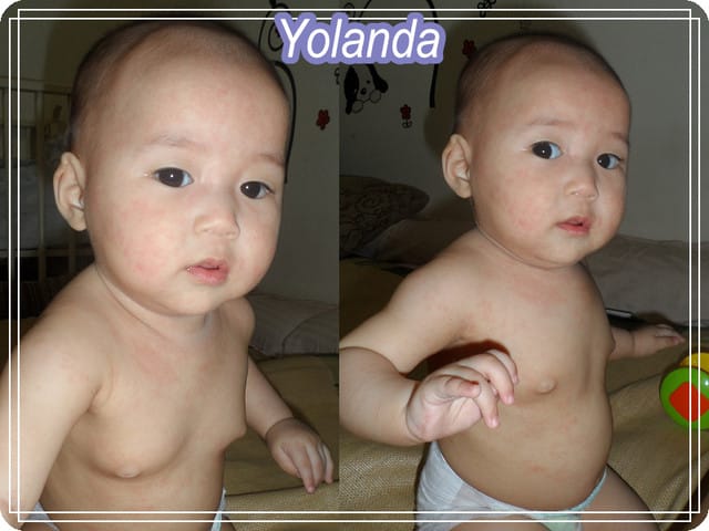 【Yolanda成長點滴】6M22D確定病毒疹
