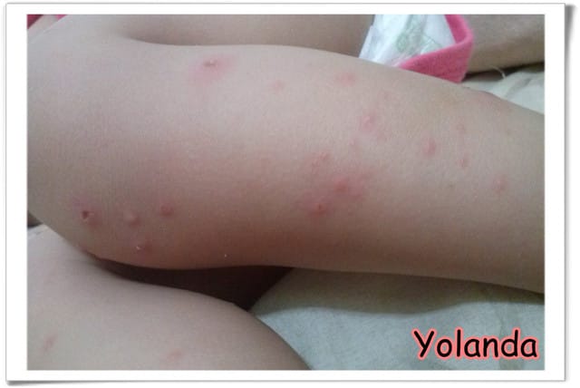 【Yolanda成長點滴】10M5D長水痘