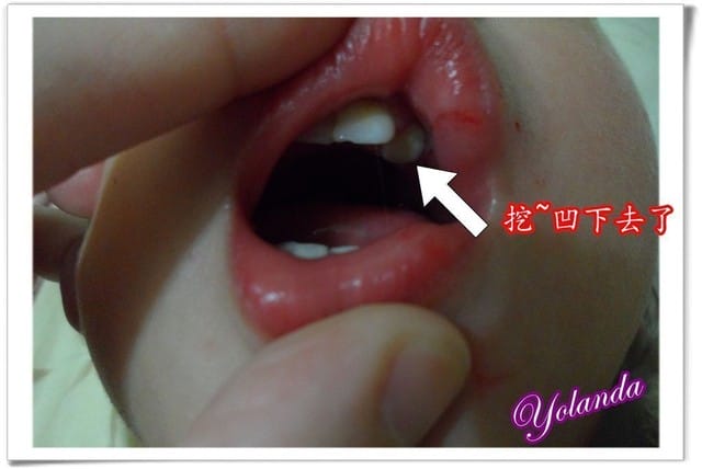 真的是悲劇了～～Yolanda拔牙記