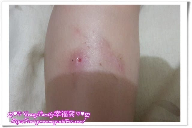 Yolanda腳傷治療完成