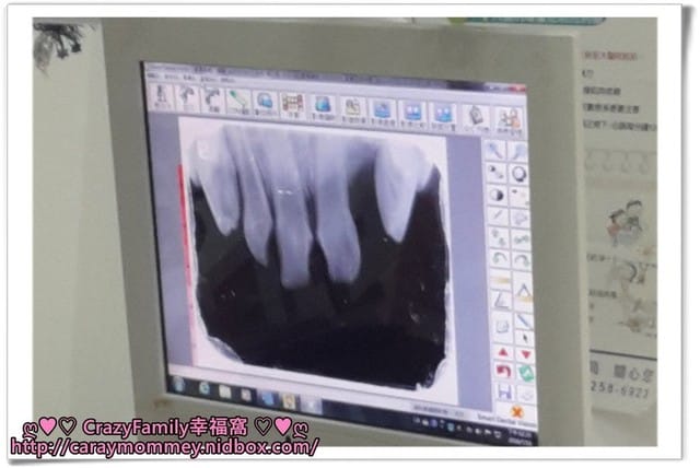 Yolanda牙科首次X光檢查