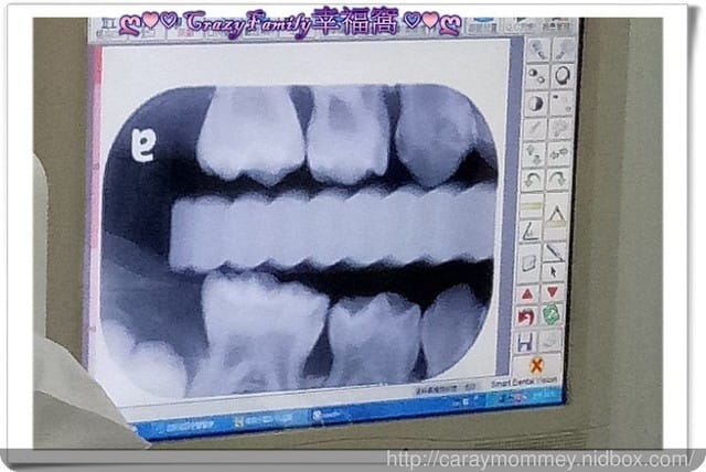 【Yolanda 4y11m】牙縫性蛀牙下排補牙
