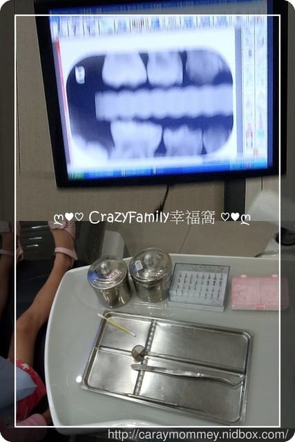 【Yolanda 4y11m】牙縫性蛀牙上排補牙