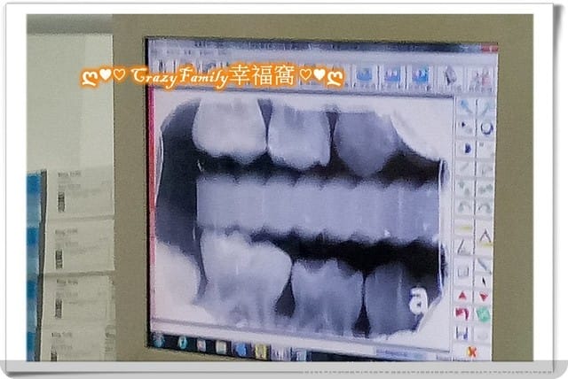 【 Yolanda 】 5y11m定期牙檢 + 塗氟 - 第6張圖 【 Yolanda 】 5y11m定期牙檢 + 塗氟
