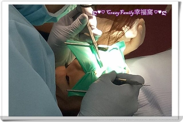 【 Yolanda 】 5y11m治療牙縫蛀牙2