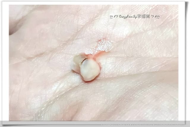 Xenia 的乳牙記錄:掉第18顆牙;右上, 第二臼齒 - 第5張圖 Xenia 的乳牙記錄:掉第18顆牙;右上, 第二臼齒