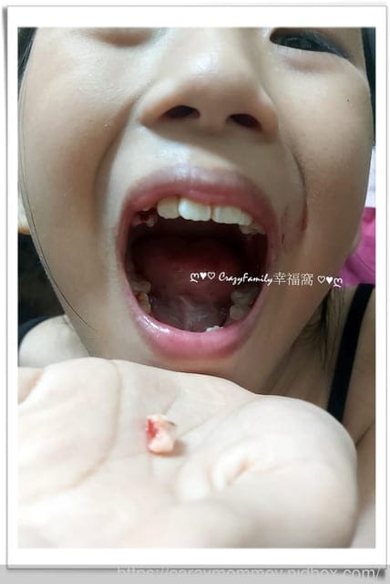 Xenia 的乳牙記錄:掉第18顆牙;右上, 第二臼齒 - 第3張圖 Xenia 的乳牙記錄:掉第18顆牙;右上, 第二臼齒