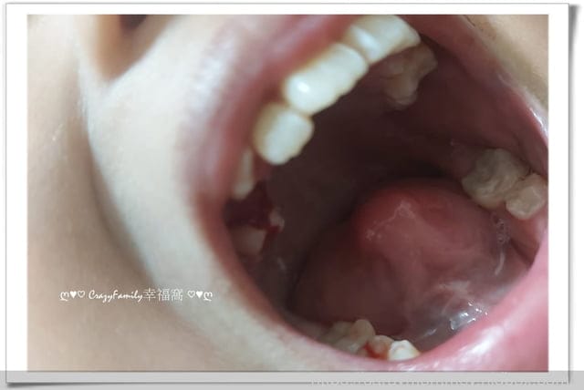 Xenia 的乳牙記錄:掉第18顆牙;右上, 第二臼齒 - 第4張圖 Xenia 的乳牙記錄:掉第18顆牙;右上, 第二臼齒