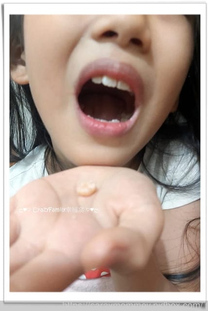 Xenia 的乳牙記錄:右下, 第二臼齒(滿11y8m乳牙全部掉光光) - 第3張圖 Xenia 的乳牙記錄:右下, 第二臼齒(滿11y8m乳牙全部掉光光)
