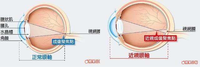 不可不知的 ♧ 學童近視矯正新科技-周邊離焦眼鏡再升級變色片