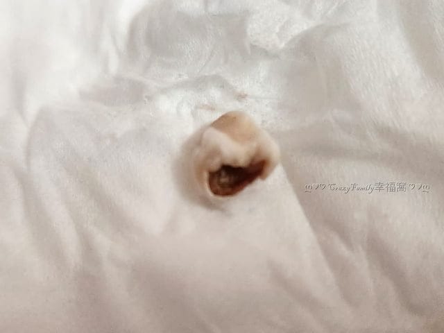 Yolanda 的乳牙記錄：左上, 第一臼齒