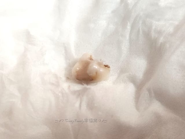 Yolanda 的乳牙記錄：左上, 第一臼齒